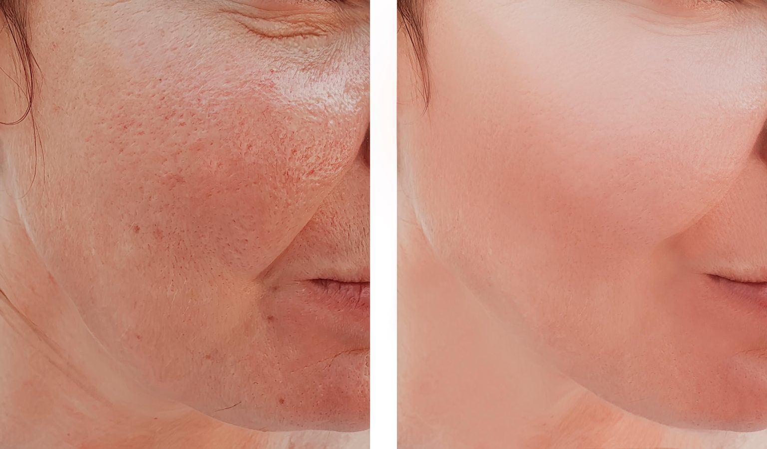 Why_Skin_Resurfacing_Could_Be_Right_For_Me-1536x899