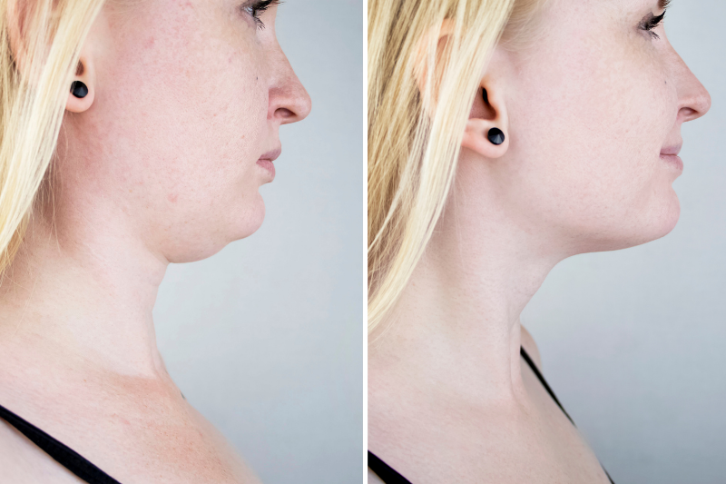 What is Kybella