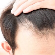 ExoFlo_Hair_Restoration_Treatments_for_Men